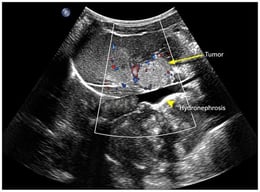 Postnatal abdominal ultrasonography demonstrating a right-sided suprarenal mass (approximately 17.7 × 14.9 mm) associated with ipsilateral hydronephrosis. The lesion is indicated by the arrow.