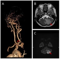 Baseline neuroimaging showing posterior circulation ischemia and vertebrobasilar occlusive disease. (A) Three-dimensional CT angiography demonstrates absent antegrade basilar artery opacification with distal posterior circulation filling through collateral pathways. (B) Axial T2-weighted MRI demonstrates signal abnormality in the left cerebellar hemisphere, consistent with subacute ischemic injury (arrow). (C) Diffusion-weighted imaging demonstrates restricted diffusion in the corresponding left cerebellar region, consistent with acute-to-subacute infarction (arrow).
