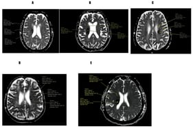 Representative apparent diffusion coefficient (ADC) map images demonstrating region-of-interest (ROI) placement for quantitative ADC measurement in five patients with acute ischemic stroke. Panels (A–E) show circular ROIs positioned within ischemic lesions to obtain quantitative measurements, including mean ADC, standard deviation, and ROI area. Uniform image dimensions were maintained across panels to facilitate visual comparison.