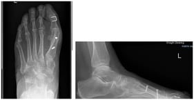 Postoperative X-rays following traditional scarf osteotomy.