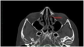 Ethmoid width at the lacrimal fossa left (EW_LF).