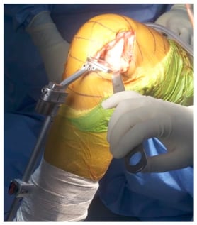Conventional unicompartmental knee arthroplasty (UKA) performed using standardized cutting jigs. Precise femoral and tibial resections are achieved with cutting guides, ensuring proper alignment, soft tissue balance, and accurate component placement.