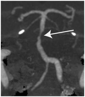 Illustrative case of a 78-year-old patient presenting with a first episode of transient vertigo and dysarthria for about 20 min. On CT-angiography a significant (i.e., >50%) stenosis of the basilar artery was detected (indicated by a white arrow). Under conservative treatment the patient continued to report recurrent episodes of transient vestibular symptoms, and thus he was referred to interventional neuroradiology for further diagnostics and treatment (courtesy of MR-image: Radiology, Cantonal Hospital of Baden, Baden).