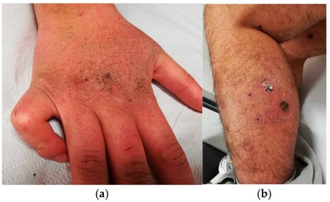 Cutaneous manifestations: skin thickening (a) and leg ulcers (b).
