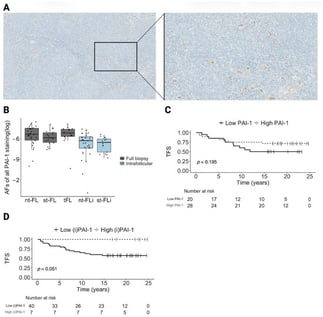 Tumoral expression of PAI-1 in FL and its association with TFS. (A) Immunohistochemical staining for PAI-1 in a diagnostic biopsy. Left: magnification at 5×, right: magnification at 10×. (B) Boxplot showing AFs of PAI-1 expression levels in full biopsy (grey) and intrafollicular areas (blue) in nt-FL, st-FL and tFL samples. No significant differences were observed. (C) Kaplan–Meier curves for TFS stratified by full biopsy PAI-1 expression (cutoff AF = 0.0029). (D) Kaplan–Meier curves for TFS stratified by intrafollicular PAI-1 expression (cutoff AF = 0.0046). Abbreviations: AF, area fraction; nt-FL, non-transforming FL; i, intrafollicular; PAI-1, Serpin family E member 1; st-FL, subsequently transforming FL; tFL, transformed FL; TFS, transformation-free survival.