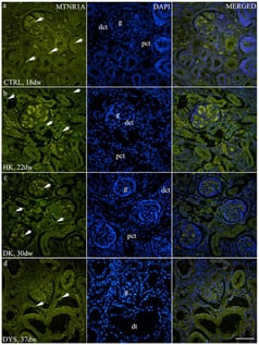 Immunofluorescence staining of (a) control human fetal kidneys (CTRL), (b) horseshoe kidneys (HK), (c) duplex kidneys (DK), and (d) dysplastic kidneys (DYS) using an antibody against melatonin receptor 1A (MTNR1A). Arrows indicate MTNR1A staining in the glomeruli (g), distal convoluted tubules (dct), dysplastic tubules (dt), and mild staining in the proximal convoluted tubules (pct), as indicated in the corresponding 4′,6-diamidino-2-phenylindole (DAPI)-stained images. All images were acquired at 40× magnification; scale bar is 50 µm.