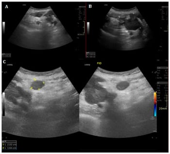 Ultrasound evaluation in Case 1. Urgent post-appendectomy ultrasound performed for abdominal pain and fever demonstrates a heterogeneous right pericecal collection with mixed anechoic and hyperechoic components (A,B). Adjacent mesenteric fat edema and hypoechoic nodular structures suspicious for lymphadenopathy are also visible (C). These atypical findings prompted second-level imaging for further characterization.