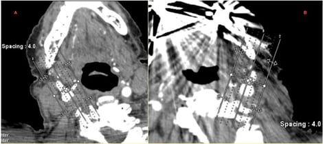 Multiplanar CTA reconstructions of the craniovertebral junction. Panels (A,B) retain the source-workstation reference lines and plane labels. The CTA study was interpreted clinically as left V3 dissection with pseudoaneurysmal dilation. The displayed workstation overlays partly obscure the vascular contour; these images provide anatomical context and do not independently demonstrate an intimal flap or motion-dependent compression.