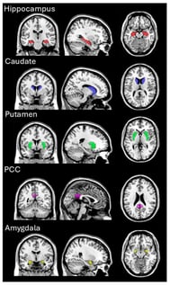 Representative T1w image showing the locations of the five ROIs: hippocampus, caudate, putamen, PCC, and amygdala.