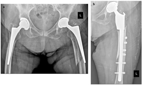 (a) The AP X-ray shows a periprosthetic fracture Vancouver B2 (b) Post-operative X-ray revision with a distal interlocking stem; (c) Four-year follow-up with consolidation of the periprosthetic fracture and absence of complications. L referred to Left.