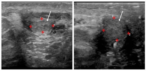 Radiological images from ultrasonography. Radiological images from ultrasonography. Scrotal ultrasound image showing small testes with no focal lesions or hydrocele. The testes size is indicated with + symbols and arrows.