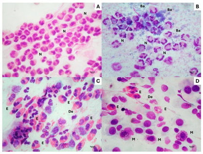Representative nasal cytological patterns in chronic rhinosinusitis without and with nasal polyps. (A) CRSsNP showing predominantly neutrophilic inflammation. (B) CRSsNP showing neutrophilic inflammation associated with abundant bacteria. (C) CRSwNP showing predominantly eosinophilic inflammation with degranulation. (D) CRSwNP showing a mixed eosinophil–mast-cell inflammatory pattern with degranulation. N, neutrophil; E, eosinophil; M, mast cell; De, degranulation; Ba, bacteria. May–Grünwald–Giemsa staining; original magnification ×1000. Scale bars = 10 μm. The cytological microphotographs are representative, fully anonymized images from the author’s teaching archive, originally obtained during routine clinical diagnostic practice and included for illustrative purposes only.