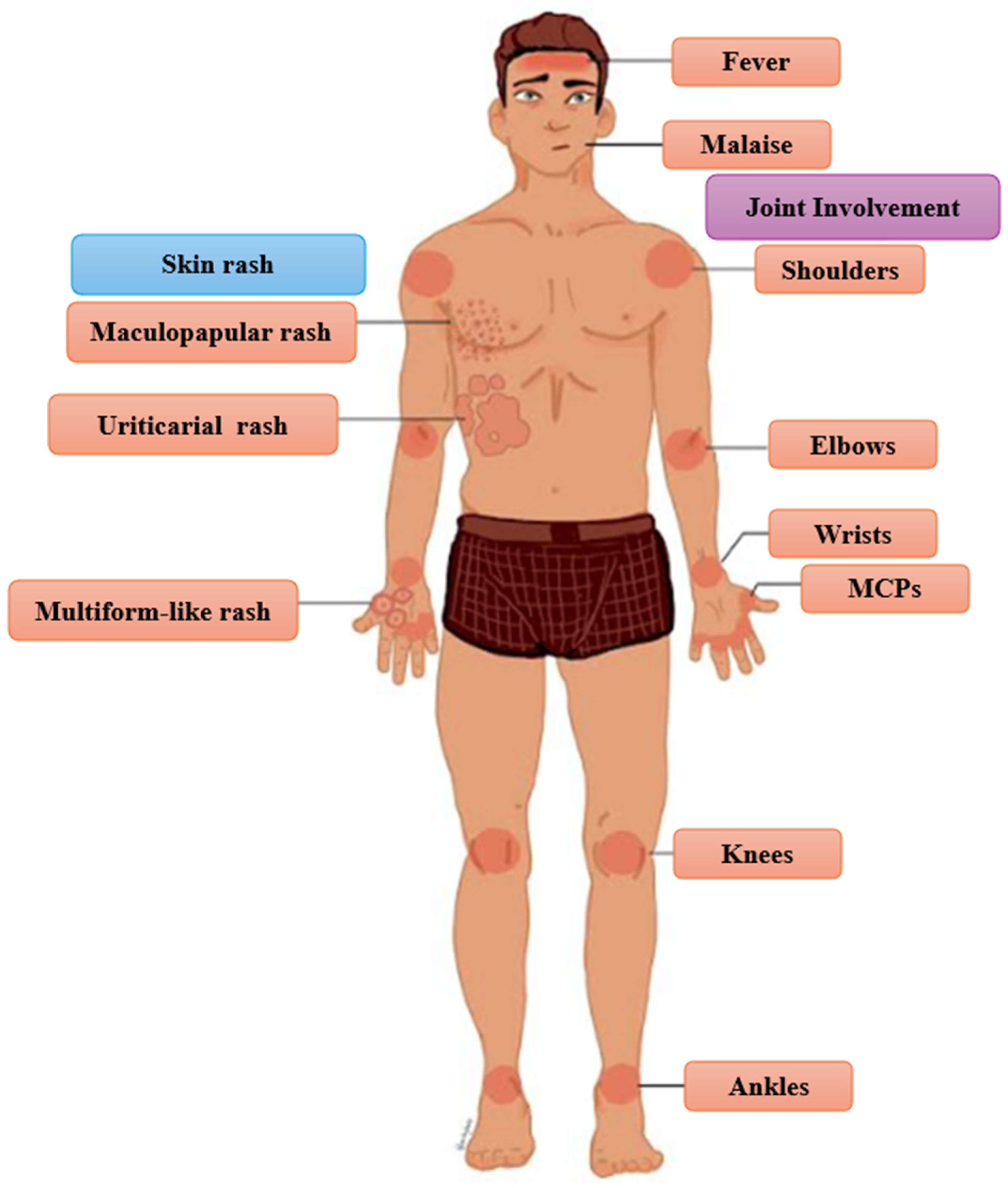 Serum Sickness-Like Reaction: A Narrative Review of Epidemiology ...