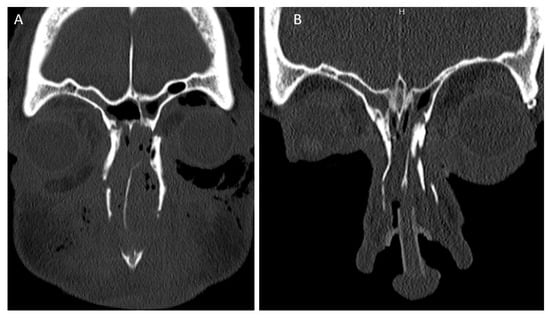 Pre-(A) and post-(B) operative reduction in canthal fragment (fixation not completely shown).