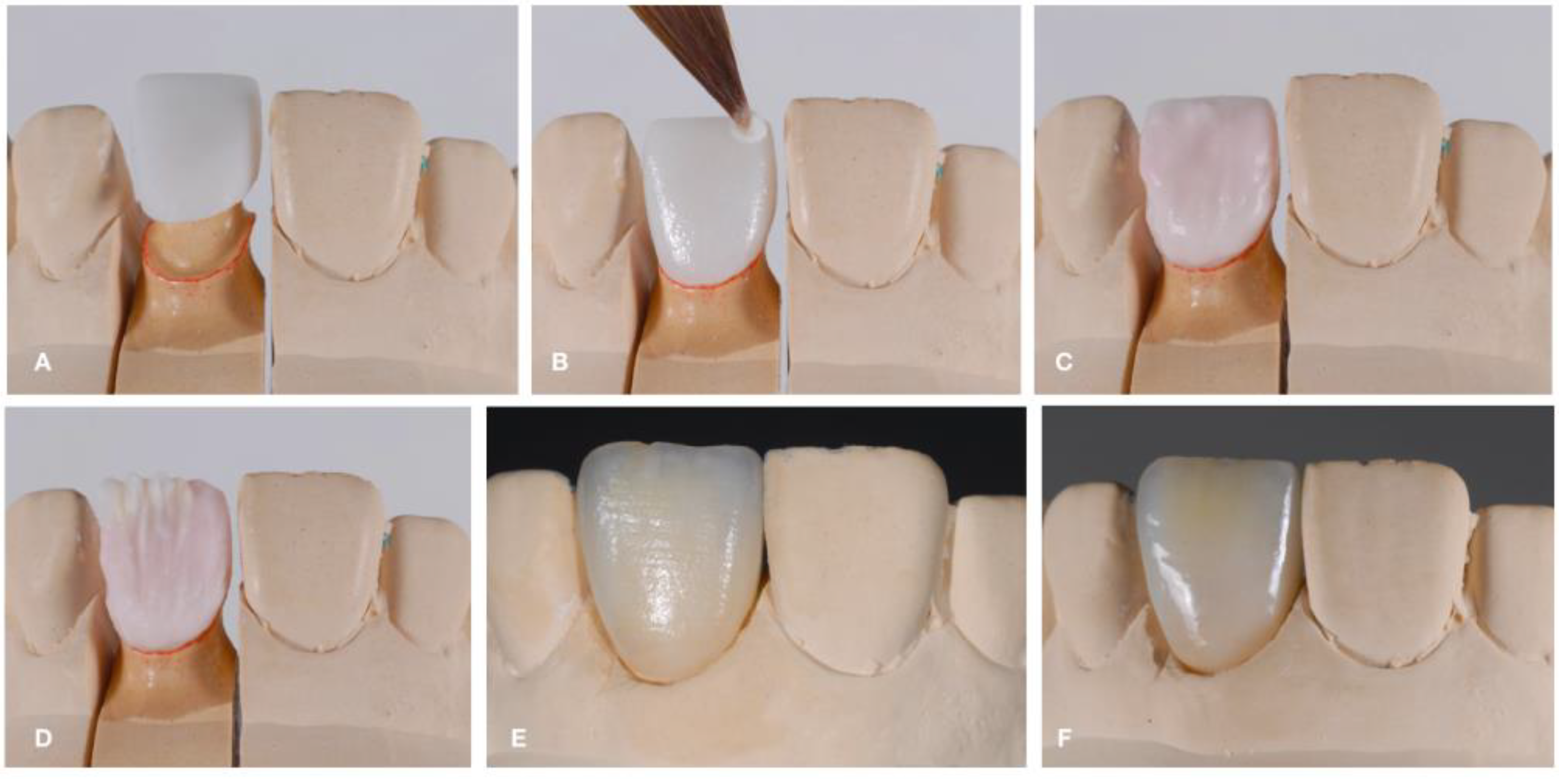 Dental Ceramics: Fabrication Methods and Aesthetic Characterization | MDPI