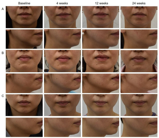 【科研】射频紧致效果可持续至24周：从临床数据，见证肤动能FP01的抗衰路径