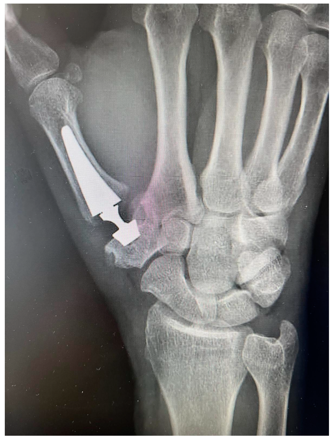 Radiographie après arthroplastie trapézo-métacarpienne