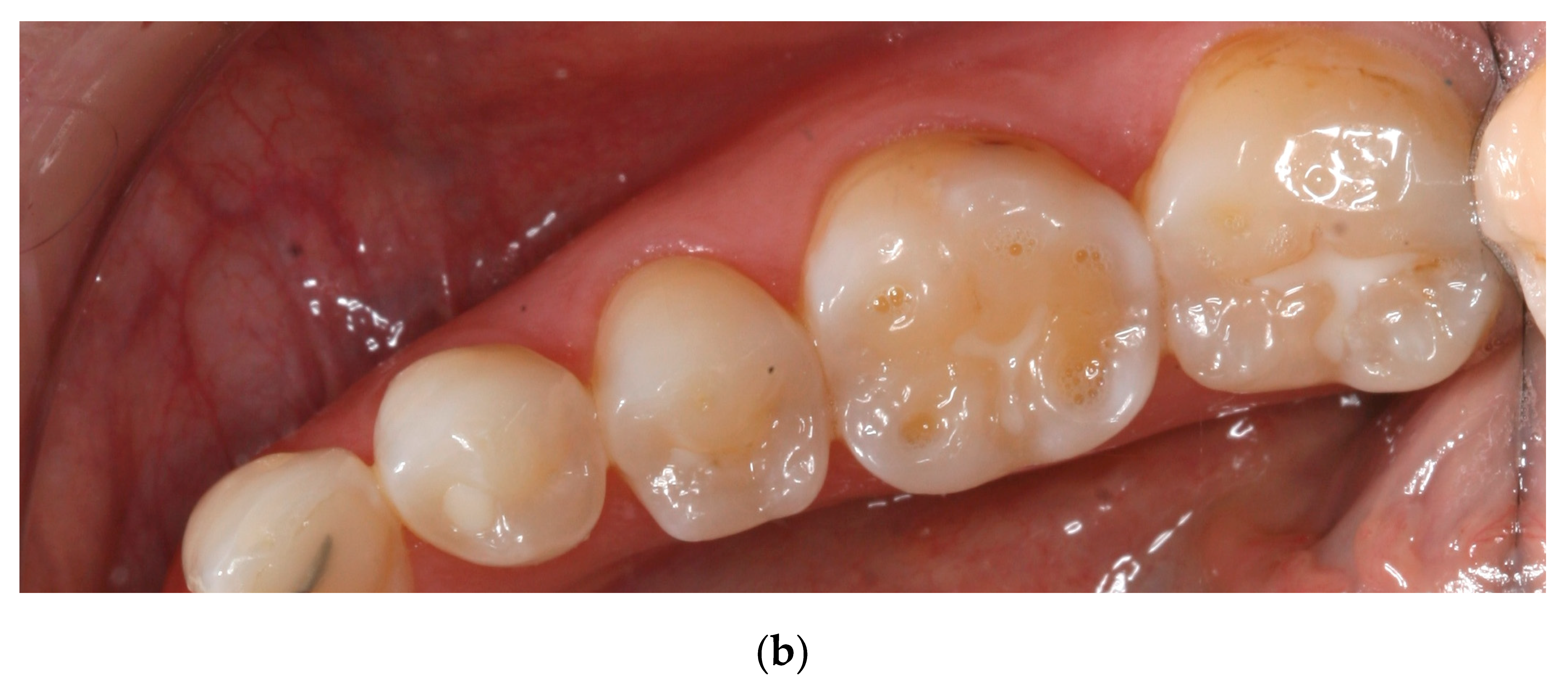 Dentistry 05 00024 g008b