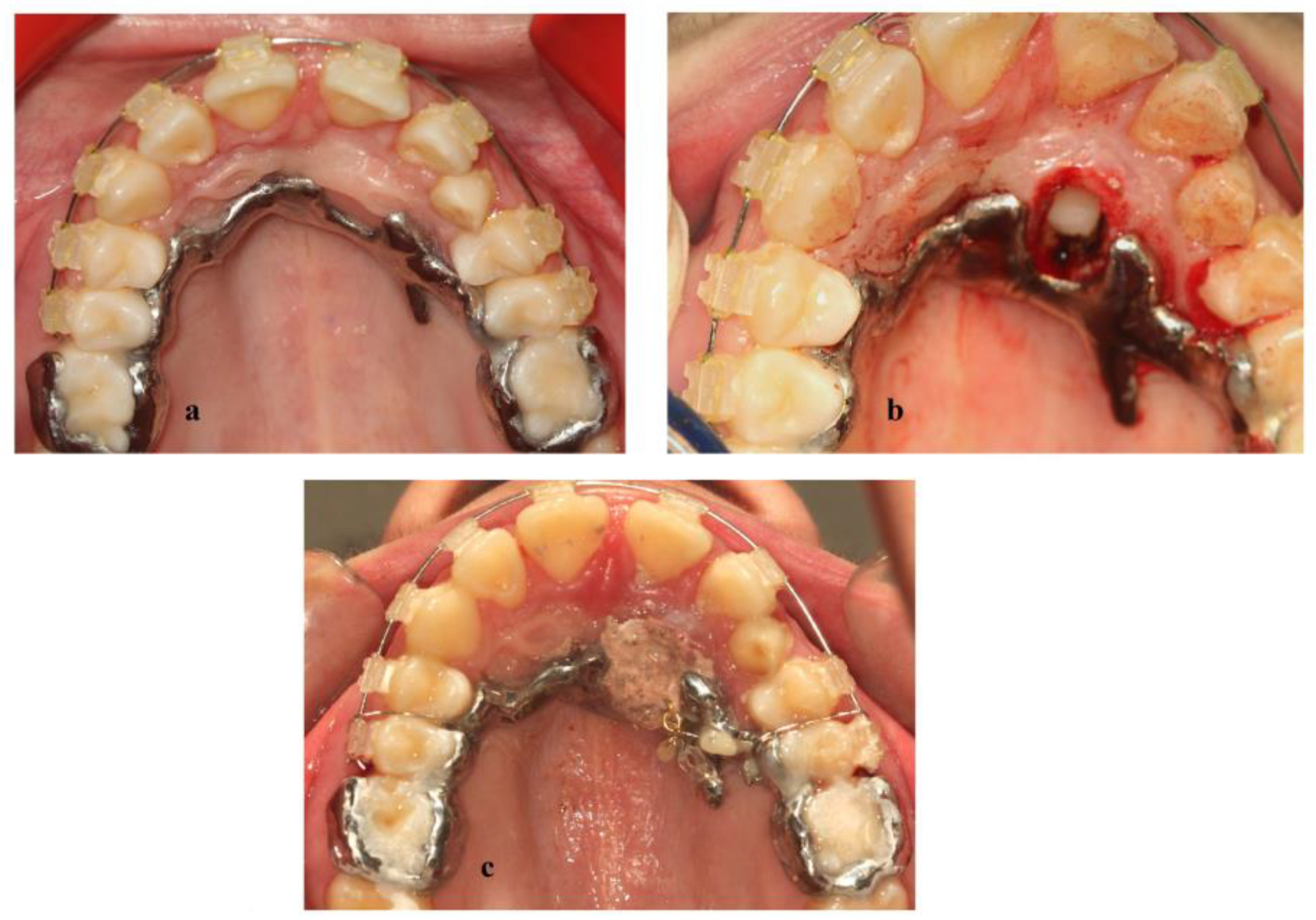 Dentistry 11 00102 g005 Dentistry 11 00102 g005