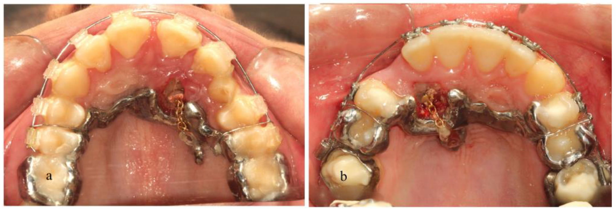 Dentistry 11 00102 g006 Dentistry 11 00102 g006