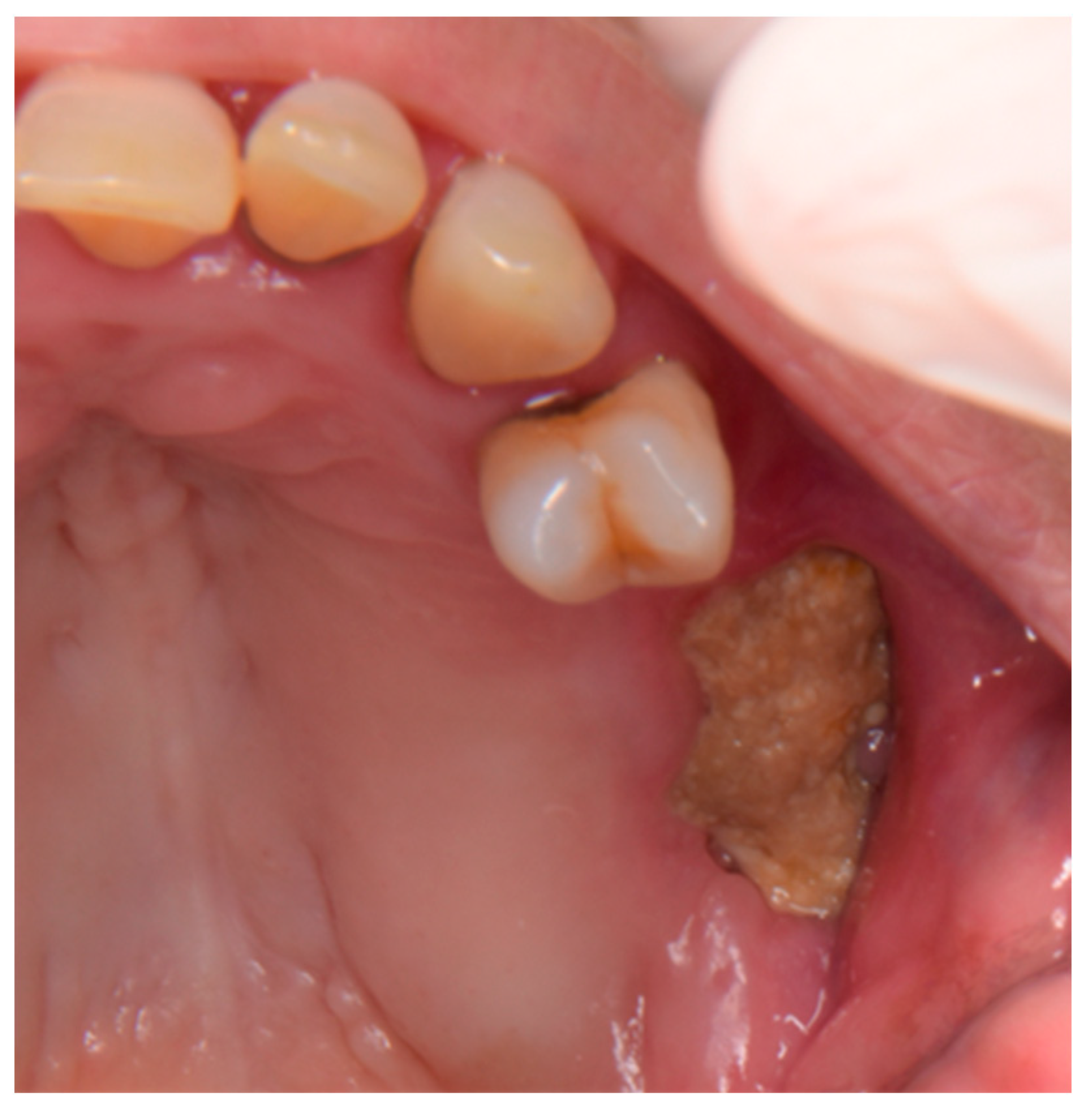 Dentistry 11 00104 g001 Dentistry 11 00104 g001