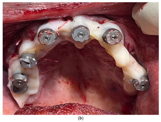 Dentistry 13 00134 g006b