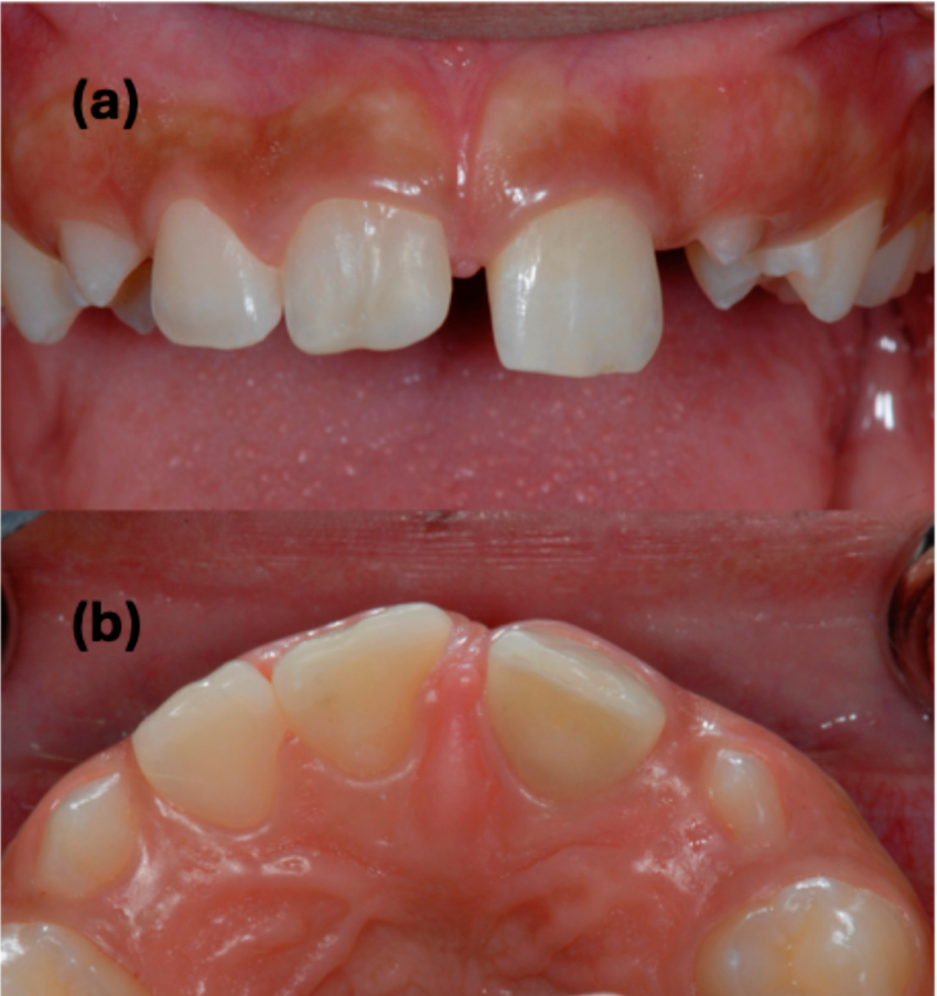 Dentistry 14 00275 g004 Dentistry 14 00275 g004