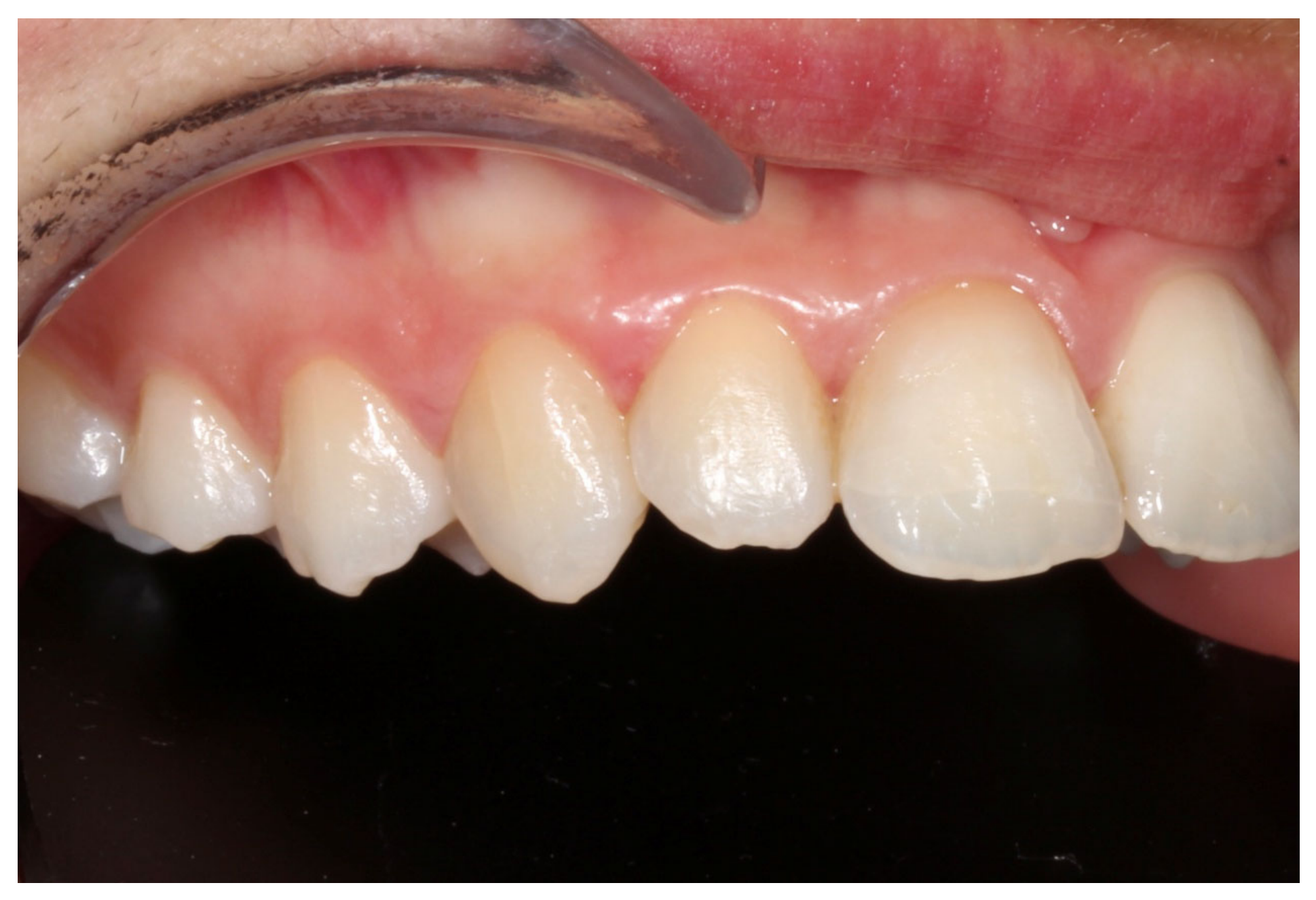 Dentistry 14 00288 g008 Dentistry 14 00288 g008