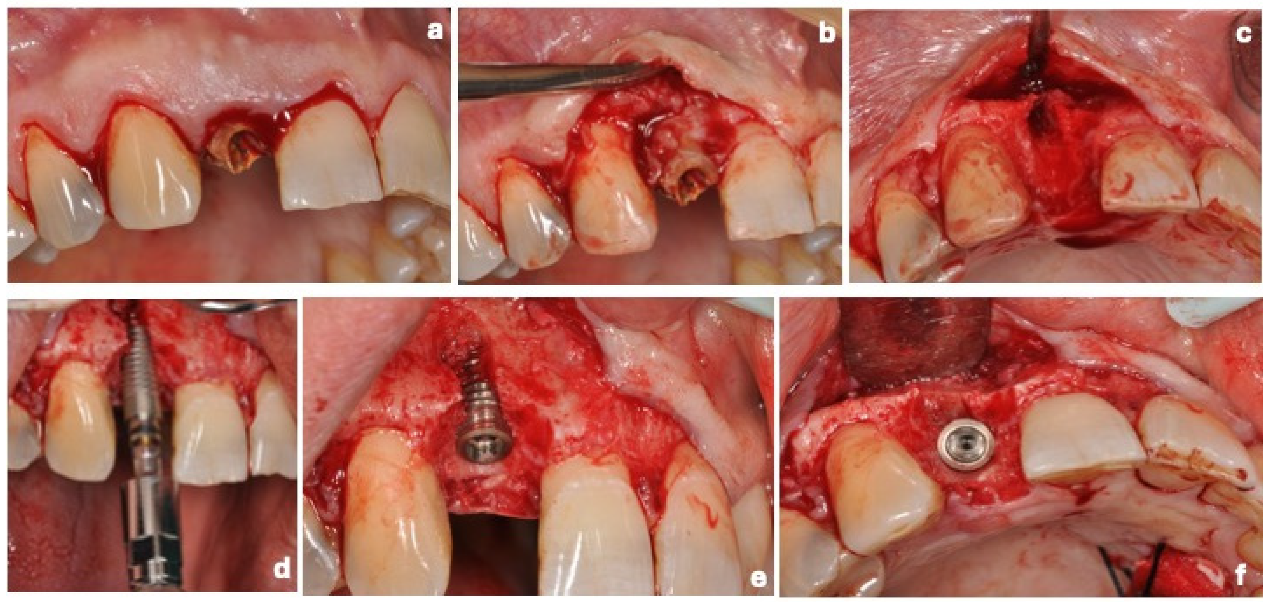 Dentistry 14 00445 g004 Dentistry 14 00445 g004