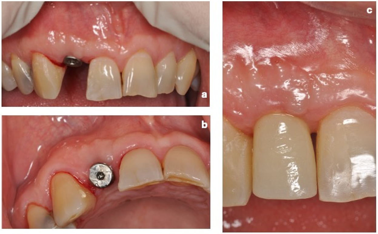 Dentistry 14 00445 g006 Dentistry 14 00445 g006