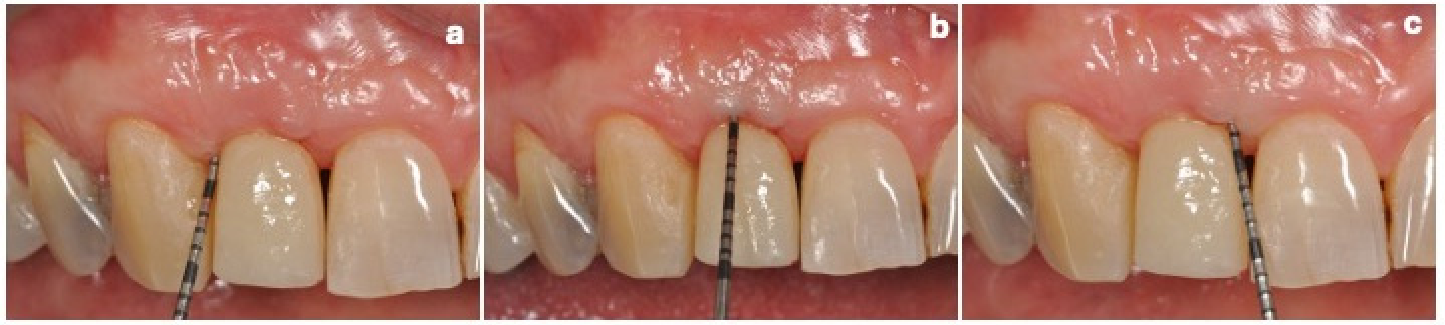 Dentistry 14 00445 g007 Dentistry 14 00445 g007