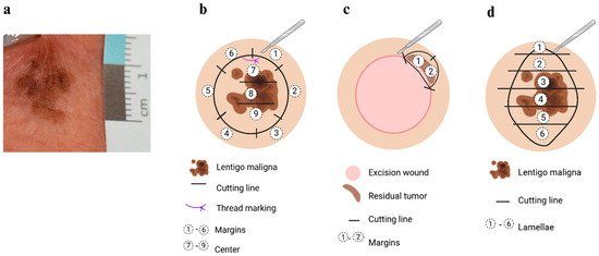 (a) Clinical appearance of lentigo maligna; (b) typical cutting and assessment of the centre and the margins of a large primary tumour; (c) re-excision in case of residual malignancy. In this example, an R0 status could not be achieved in the 12–1 o’clock and 1–2 o’clock ranges; (d) typical cutting and assessment of small spindle excision biopsies, which are processed in lamellae. Created in BioRender. Mitteldorf, C. (2025) https://BioRender.com/prv9047.