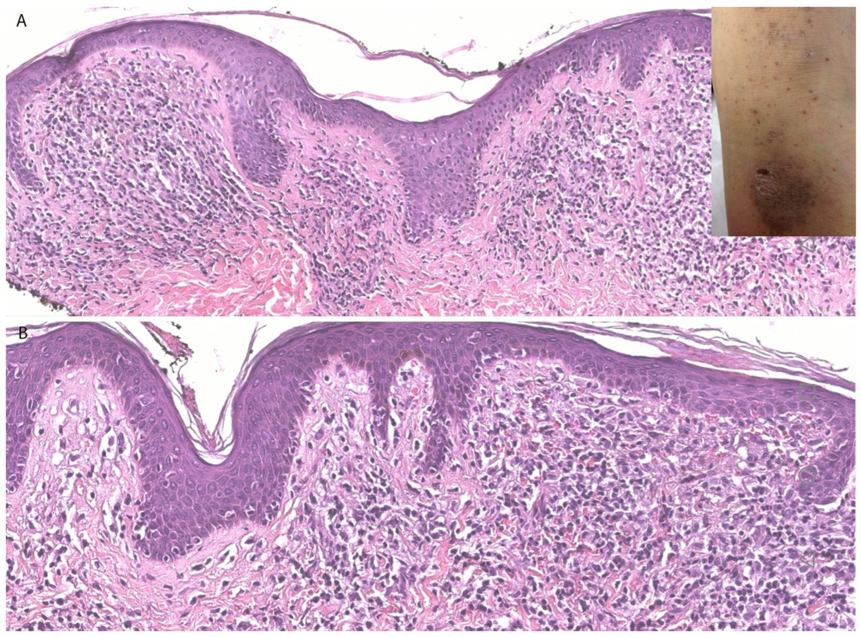 Dermatopathology 13 00023 g004 Dermatopathology 13 00023 g004