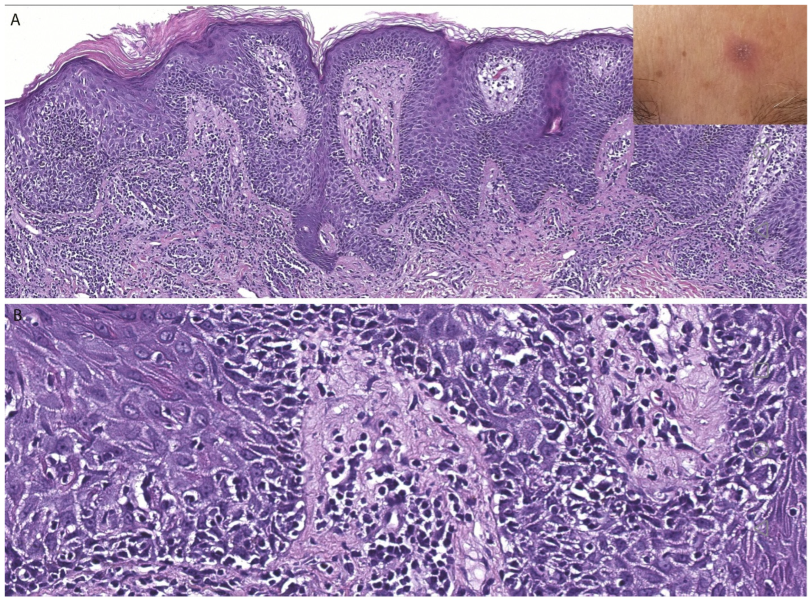 Dermatopathology 13 00023 g006 Dermatopathology 13 00023 g006
