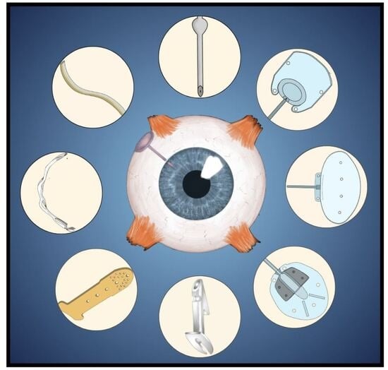 Aqueous humor dynamics. Aqueous humor formed by the ciliary body follows a circuitous pathway to the anterior chamber via the posterior chamber, pupil, and ultimately exits through the trabecular meshwork (a) and the uveoscleral pathway (b).
