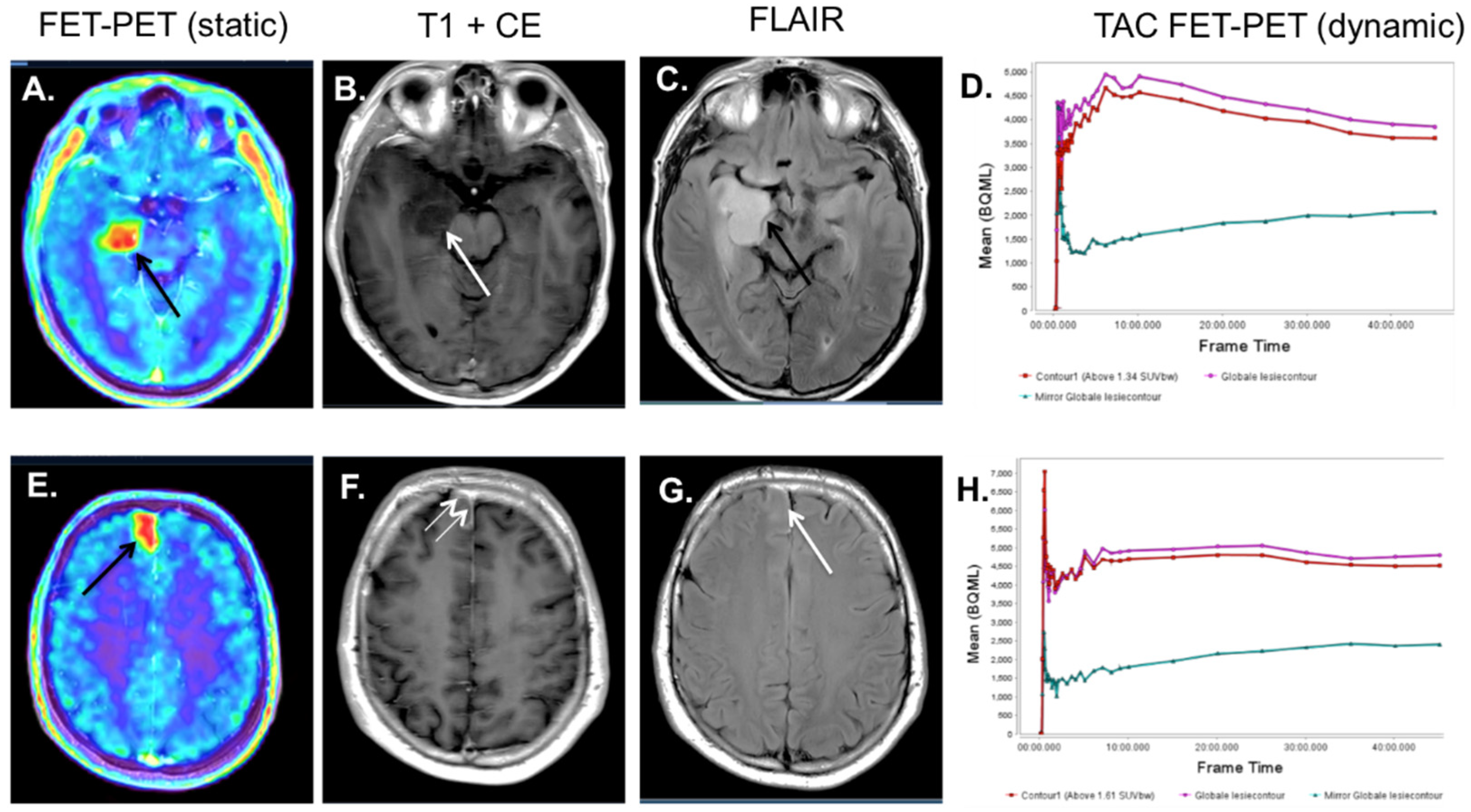 The Use of 18F-FET-PET-MRI in Neuro-Oncology: The Best of Both Worlds—A ...