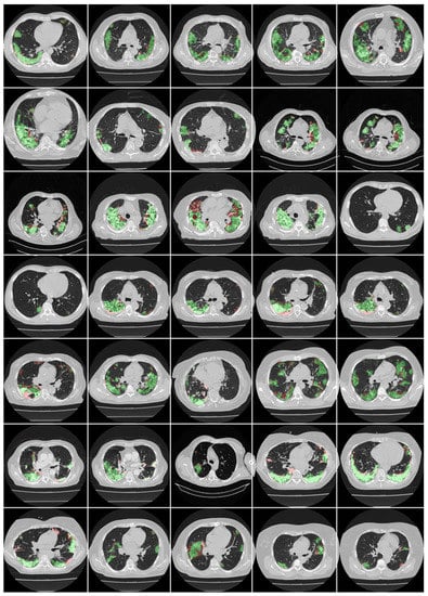 Diagnostics 12 01283 g0a5