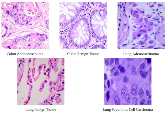 A Framework for Lung and Colon Cancer Diagnosis via Lightweight Deep ...