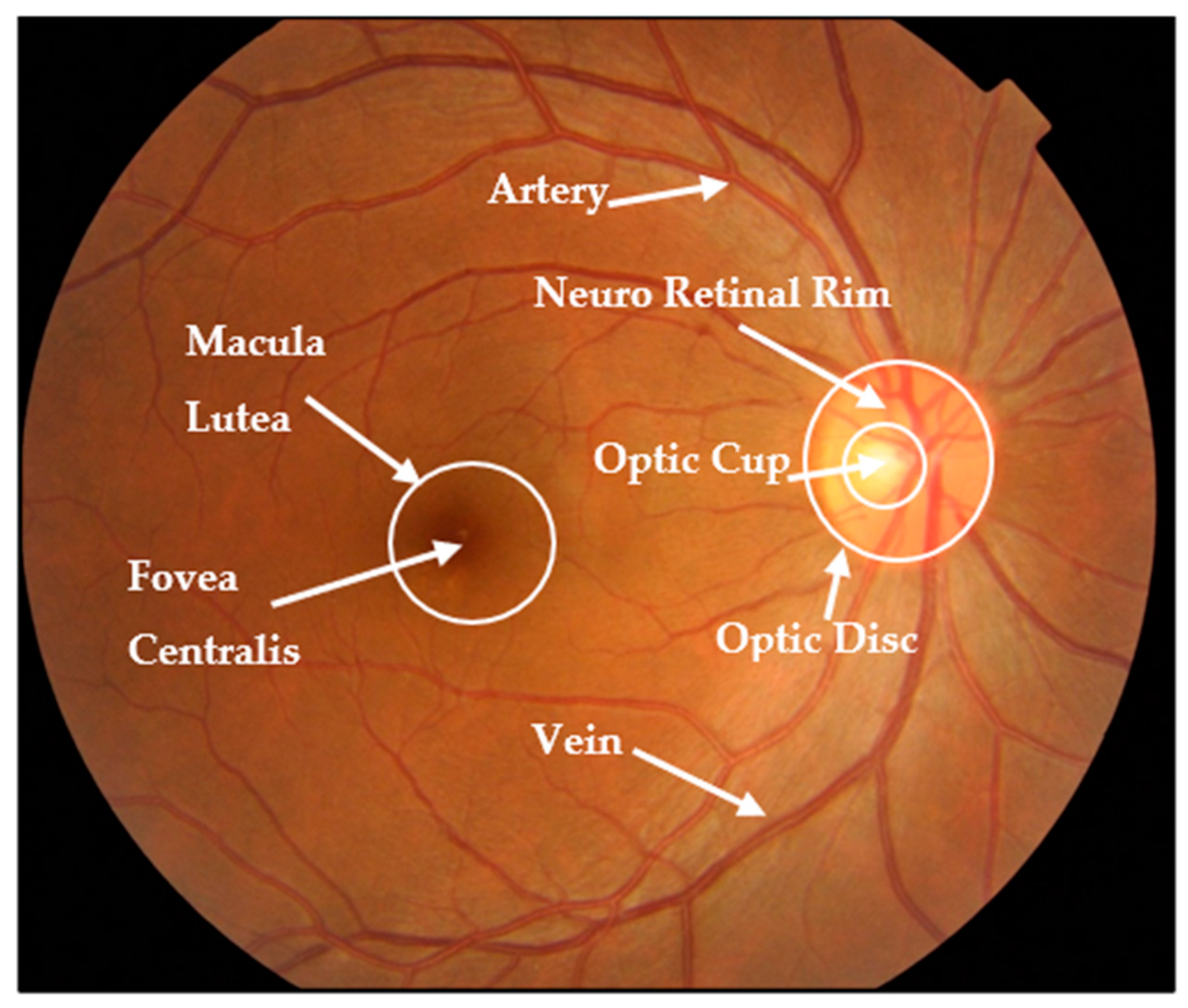 Automated Glaucoma Screening and Diagnosis Based on Retinal Fundus ...