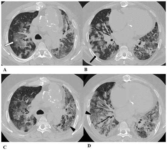 Diagnostics 14 00613 g004