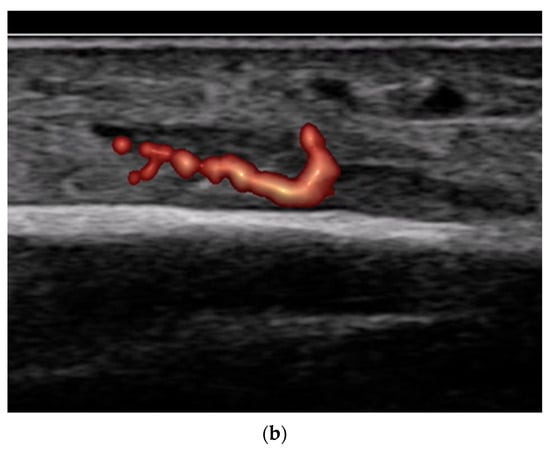 Diagnostics 15 01827 g012b