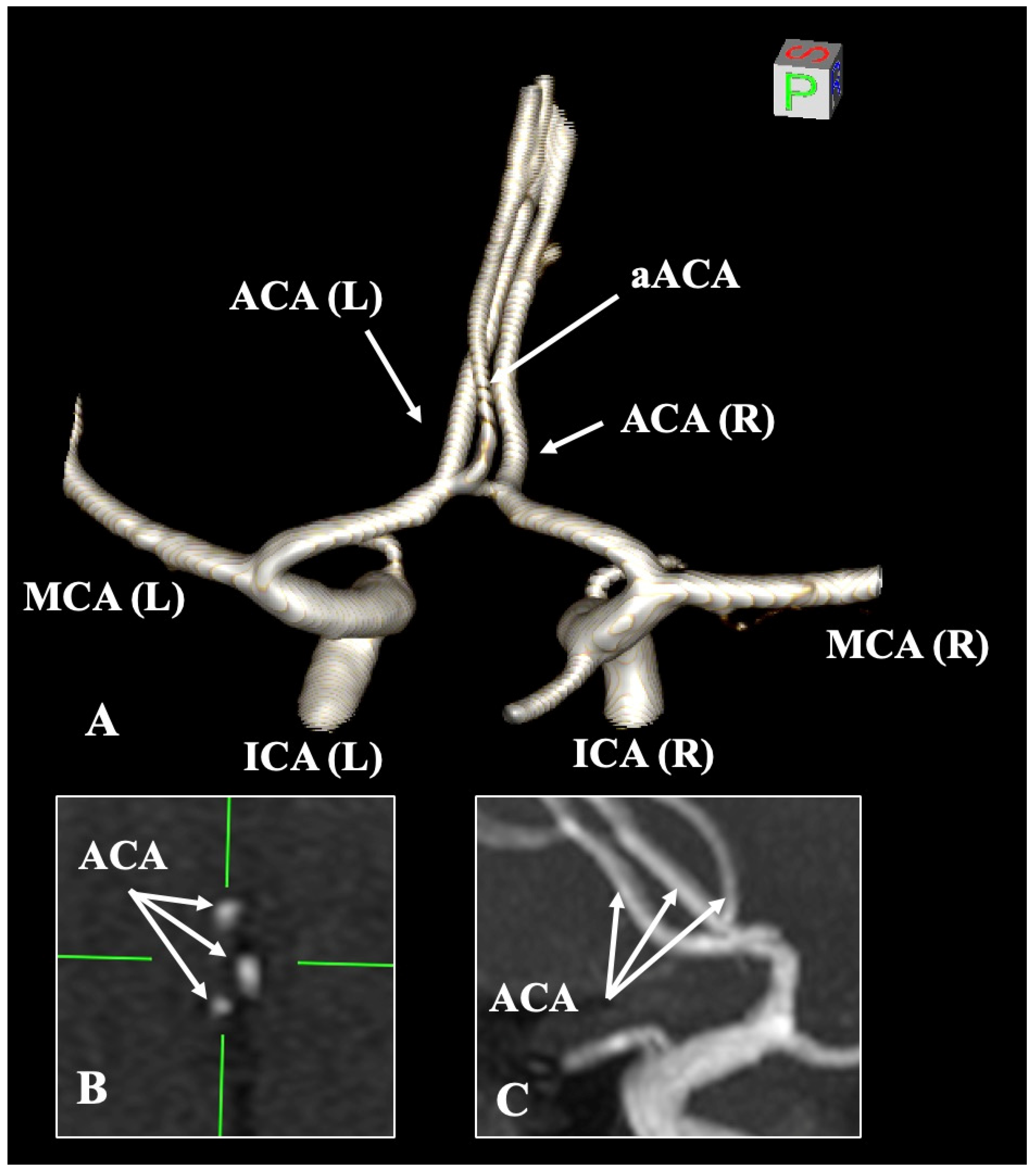 Morphological Variations of the Anterior Cerebral Artery: A Systematic ...