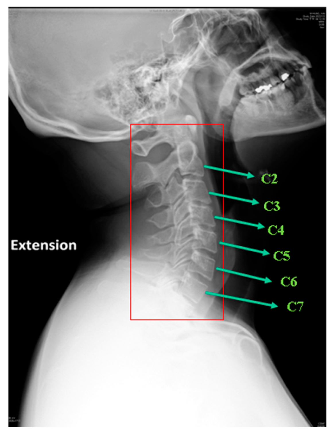 Deep Learning for Cervical Spine Radiography: Automated Measurement of ...