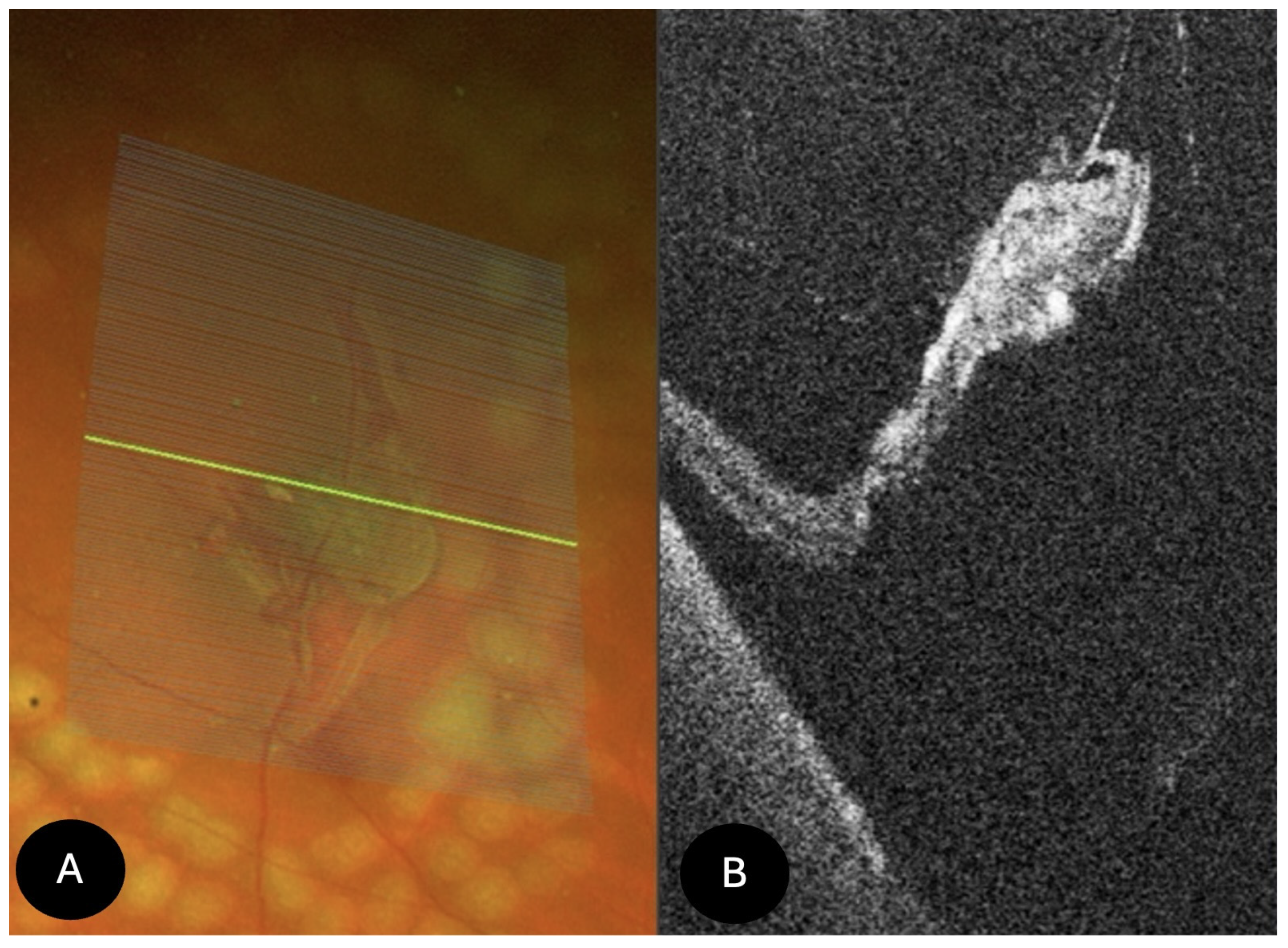Widefield image of a peripheral retinal tear surrounded by laser scars, with OCT