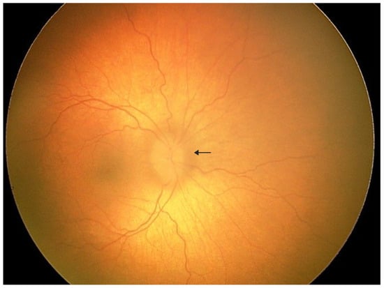 A 3-year-old boy was admitted to the pediatric ophthalmology department for diagnostic evaluation. The patient has a confirmed diagnosis of geleophysic dysplasia. He was born from the first pregnancy and first delivery at 40 weeks of gestation via spontaneous vaginal delivery, with a birth weight of 3640 g, length of 50 cm, head circumference of 34 cm, and Apgar score of 10. No congenital malformations were noted at birth; however, positional asymmetry was observed, and physiotherapy was initiated. At 5 months of age, failure to thrive and poor linear growth were noted. Despite nutritional interventions under gastroenterological supervision, growth parameters remained below normal. Abdominal ultrasound revealed hepatomegaly, and echocardiography demonstrated mitral valve stenosis, which required mechanical valve implantation. Physical examination showed coarse facial features, reversed epicanthal folds, broad nasal bridge, mild brachydactyly, short and broad hands, and broad feet. Mucopolysaccharidosis was excluded. Genetic testing revealed a heterozygous c.5198G>A variant in the FBN1 gene, not present in either parent. Based on the clinical presentation and genetic findings, geleophysic dysplasia was diagnosed. Initial ophthalmologic examination showed hyperopia of +5.0 D and astigmatism. The patient was referred from the emergency department to the ophthalmology ward for further evaluation due to elevated intraocular pressure (IOP) in the left eye, blurred optic disc margins, and left convergent strabismus. Under general anesthesia, detailed ophthalmologic assessment was performed. IOP measured 19 mmHg in the right eye and 22 mmHg in the left eye. Although the IOP in the left eye was slightly above the upper pediatric reference range, it did not meet diagnostic criteria for ocular hypertension or glaucoma, as no structural or functional glaucomatous changes were present. Refractometry demonstrated hyperopia of +3.75 D in the right eye and +5.75 D in the left eye with significant astigmatism in both eyes. Fundus examination of the left eye revealed a pink optic disc with blurred margins, slightly elevated above the retinal plane, absent foveal reflex, and tortuous vessels. The arrow indicates the blurred optic disc margin.