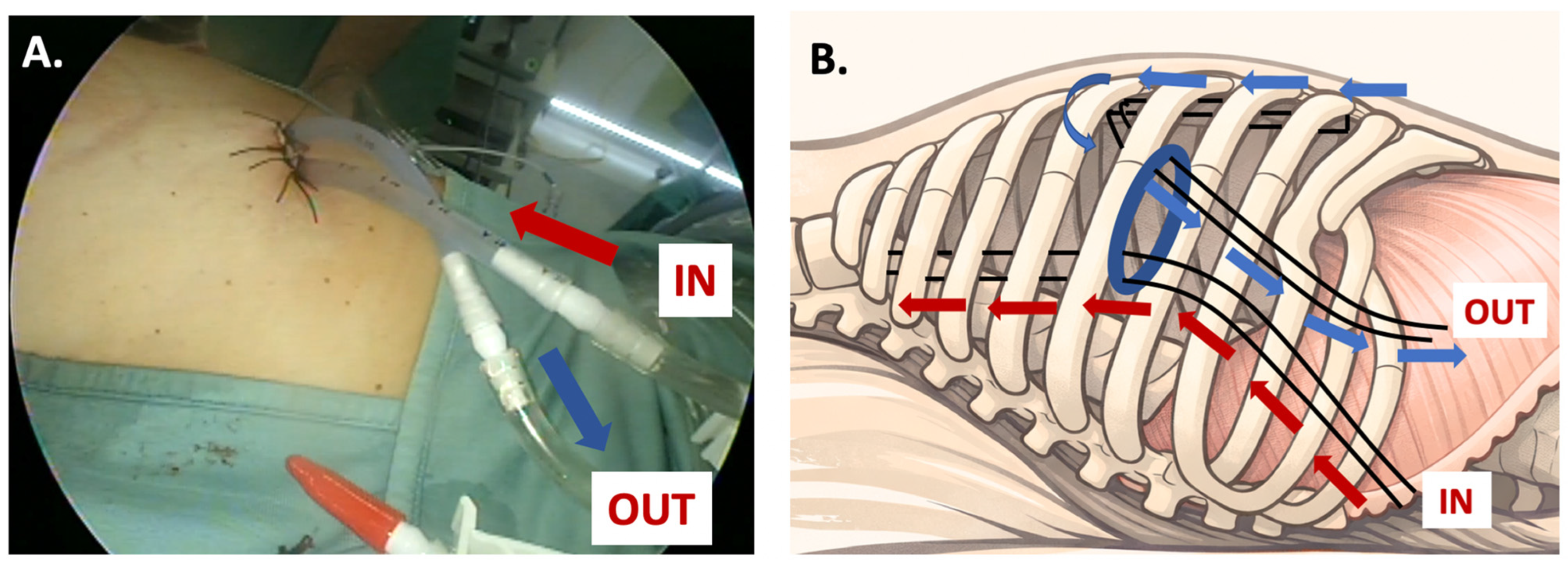 The “Heat-and-Cold” Strategy: Combining Intercostal Nerve Cryoablation ...