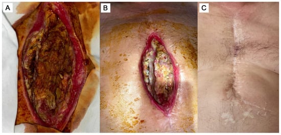 The state of the surgical wound before (A), 6 days after the commencing of cell product administration as an additive to the surgical correction (B), and 4 years after the treatment (C).