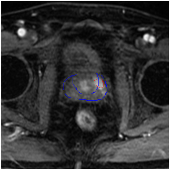 Overlay of a DCE image of a select patient, slice, and time moment with contours for peripheral zone (blue) and cancer lesion (red) masks.