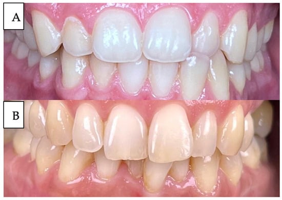 Tooth color change from younger (A) to an older adult (B).