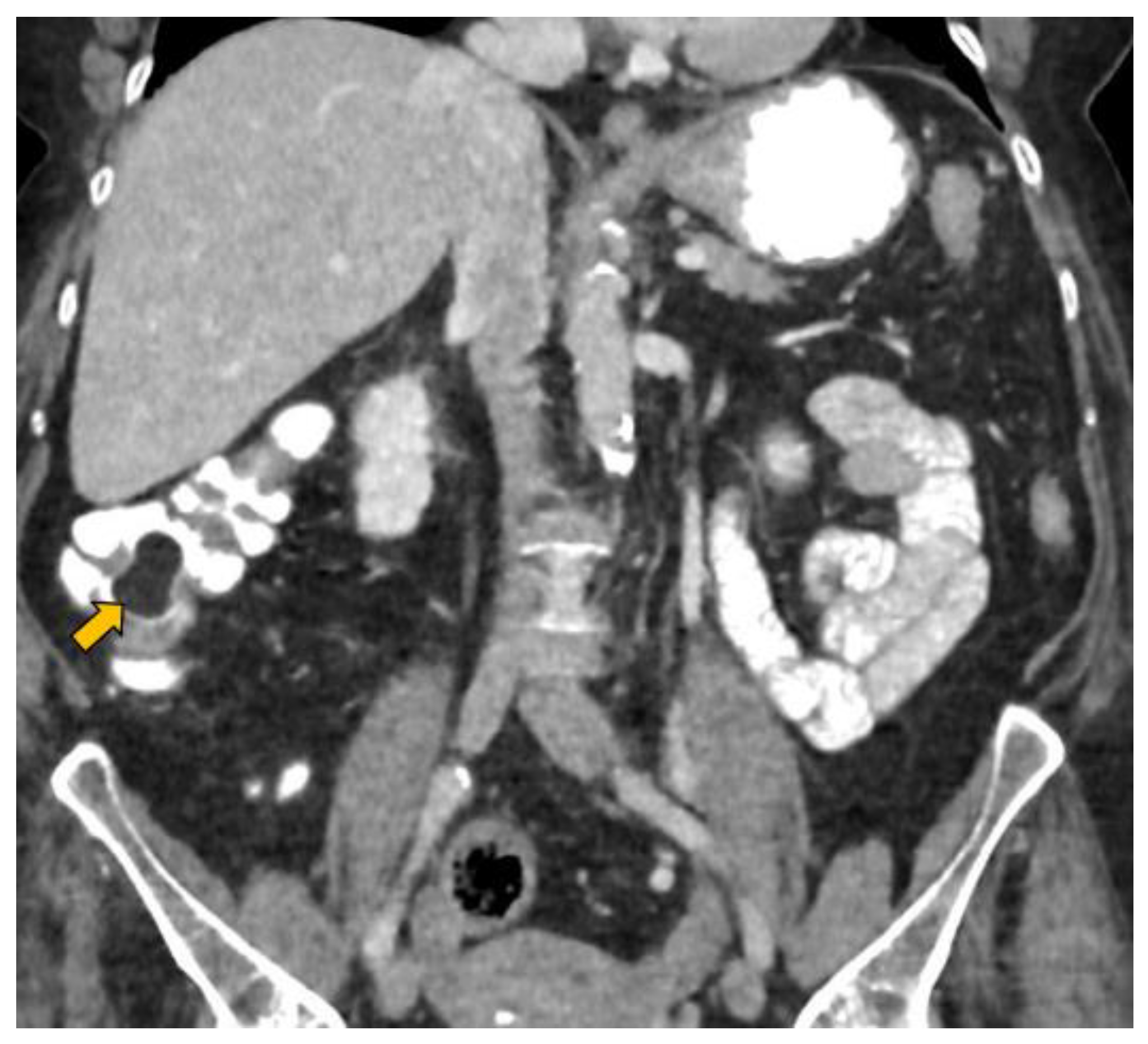 Gastroent 13 00018 g002 Gastroent 13 00018 g002